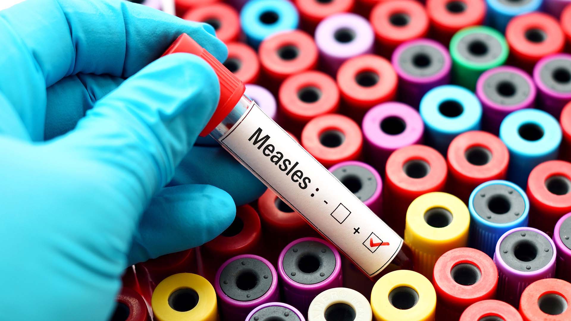 More than the source of a vaccine controversy, measles can be a serious disease